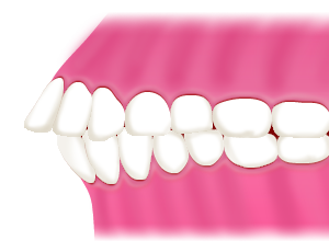上顎前突（出っ歯）の原因・リスク